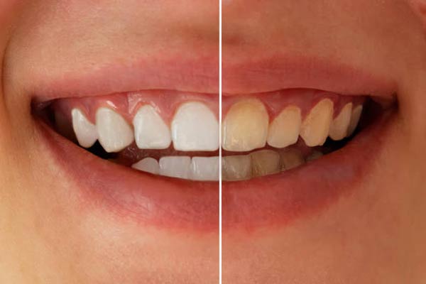 روش سفید کردن کامپوزیت دندان