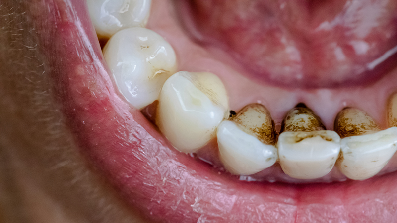 علت تیره شدن دندان ها