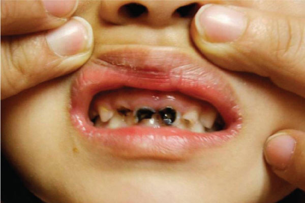 علت سیاهی دندان کودکان