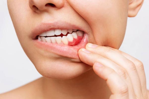 التهاب دندان