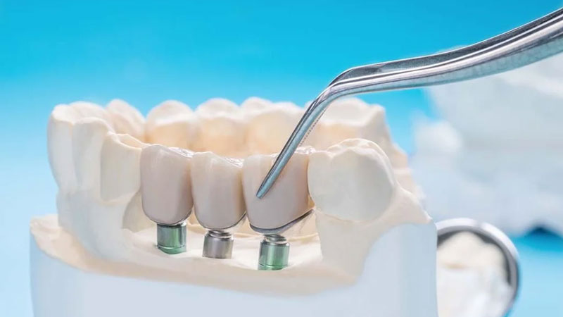 مراقبت های پس از پروتز دندان