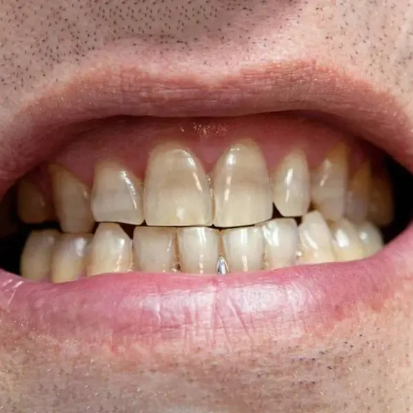  از بین بردن جرم سیاه دندان