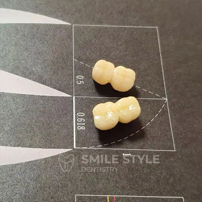 بریج دندان