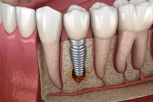 تاثیرات منفی ایمپلنت دندان