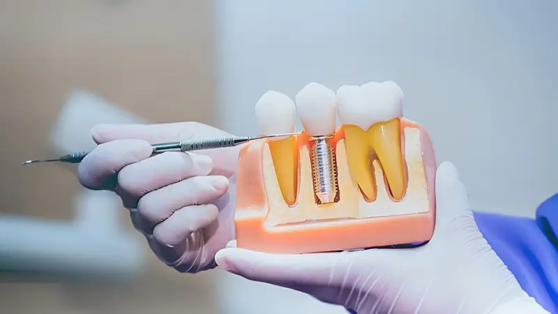 دکتر ایمپلنت دندان در تهران