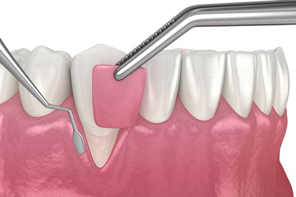 جراحی زیبایی دندان جلو پریودنتال