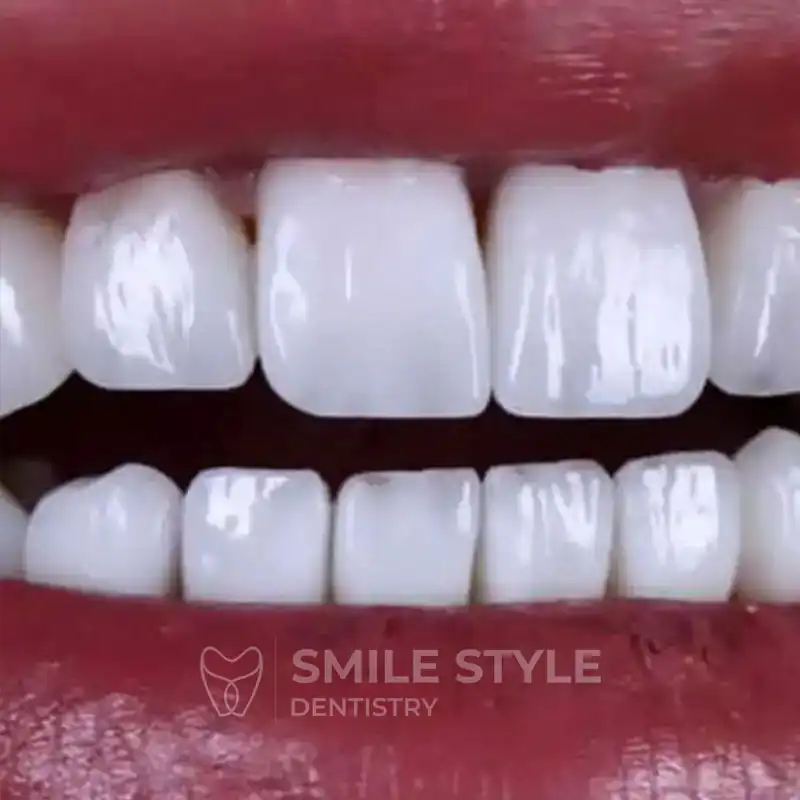 مدل دندان هالیوودی