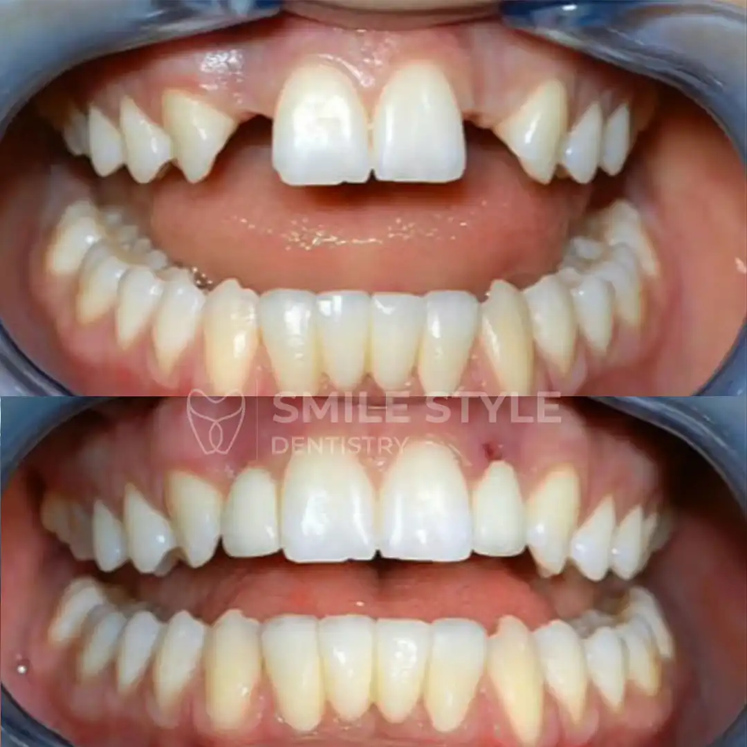 ایمپلنت دندانپزشکی زیبایی