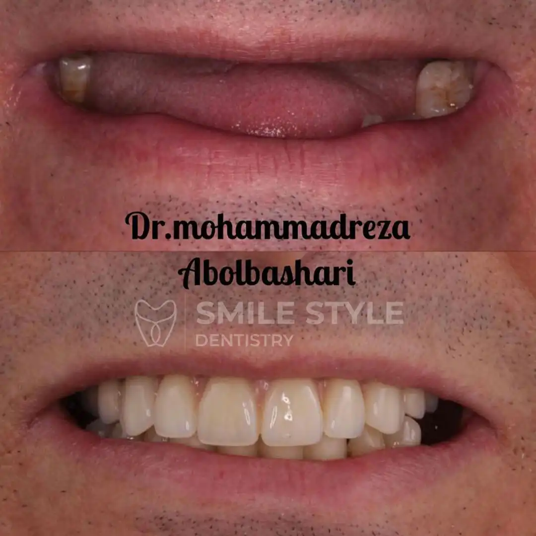 ایمپلنت دندان قبل و بعد