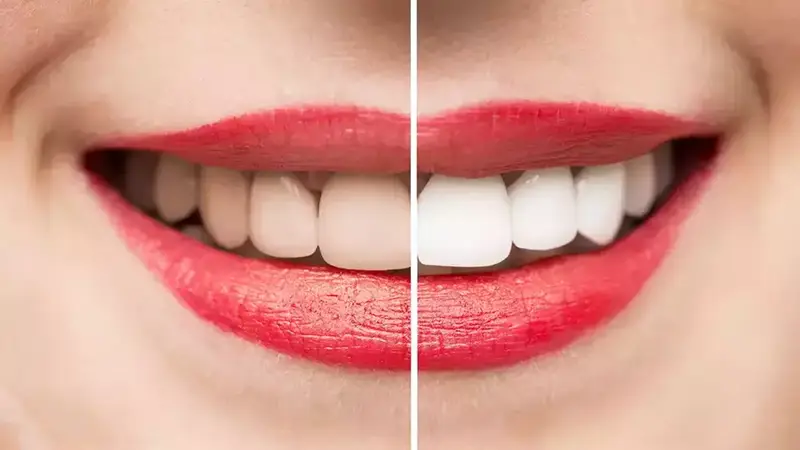 جلوگیری از سیاه شدن دندان