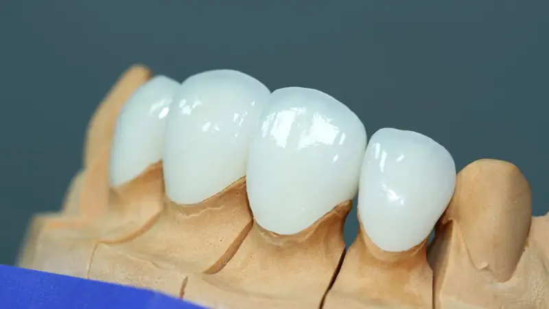 انواع روکش دندان سرامیکی