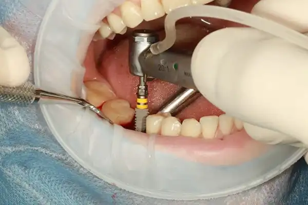 قرار دادن پایه ایمپلنت دندان
