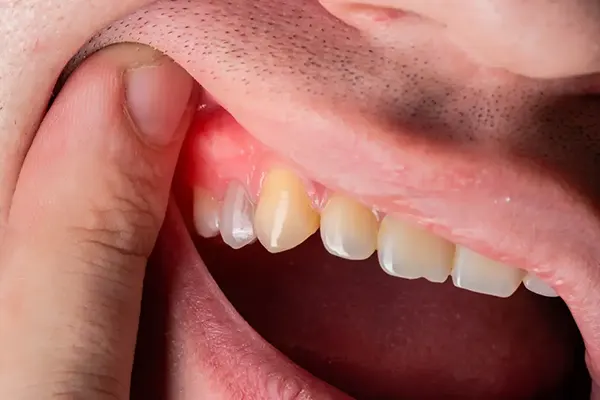 سیاه شدن دندان عصب کشی شده