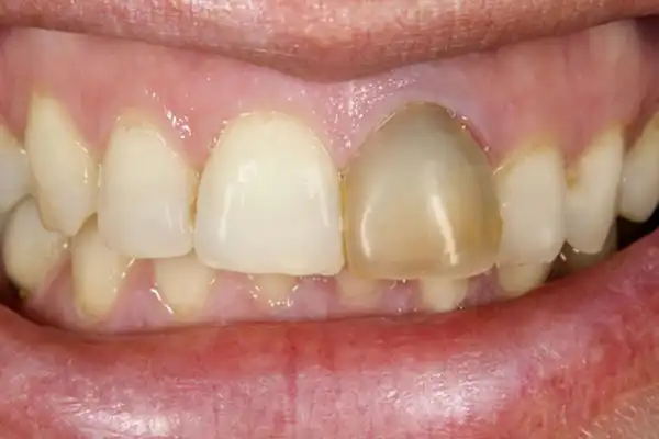 علت سیاهی دندان پر شده
