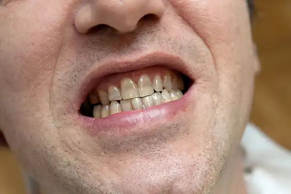 ازبین‌بردن لکه‌های سیاه‌ روی دندان