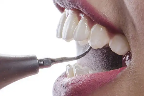 جرم گیری دندان یا Teeth Scaling چیست؟