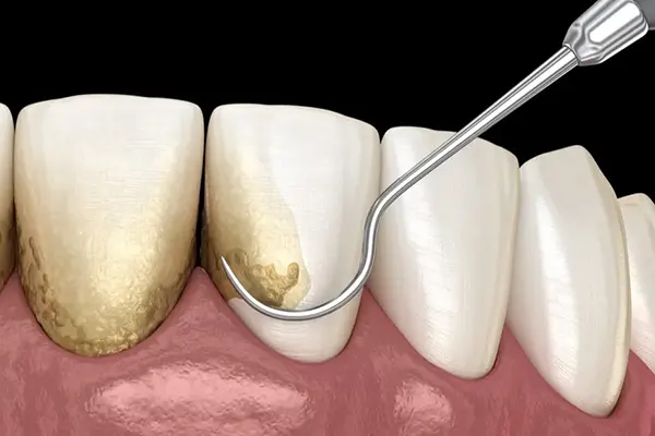  عوارض جرم گیری دندان