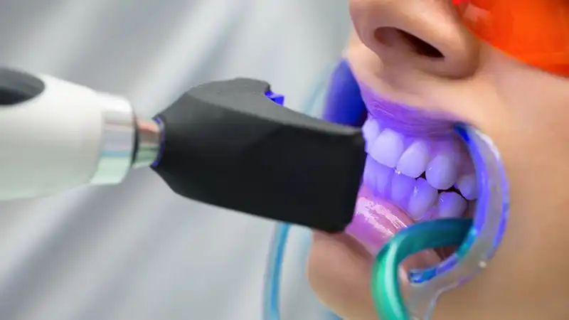 سفید کردن دندان در دندانپزشکی